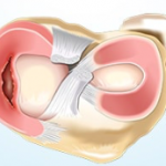 Bucket handle meniscal injury