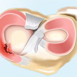 Flap meniscal injury