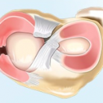 Parrot beak meniscal injury