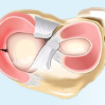 Radial meniscal injury